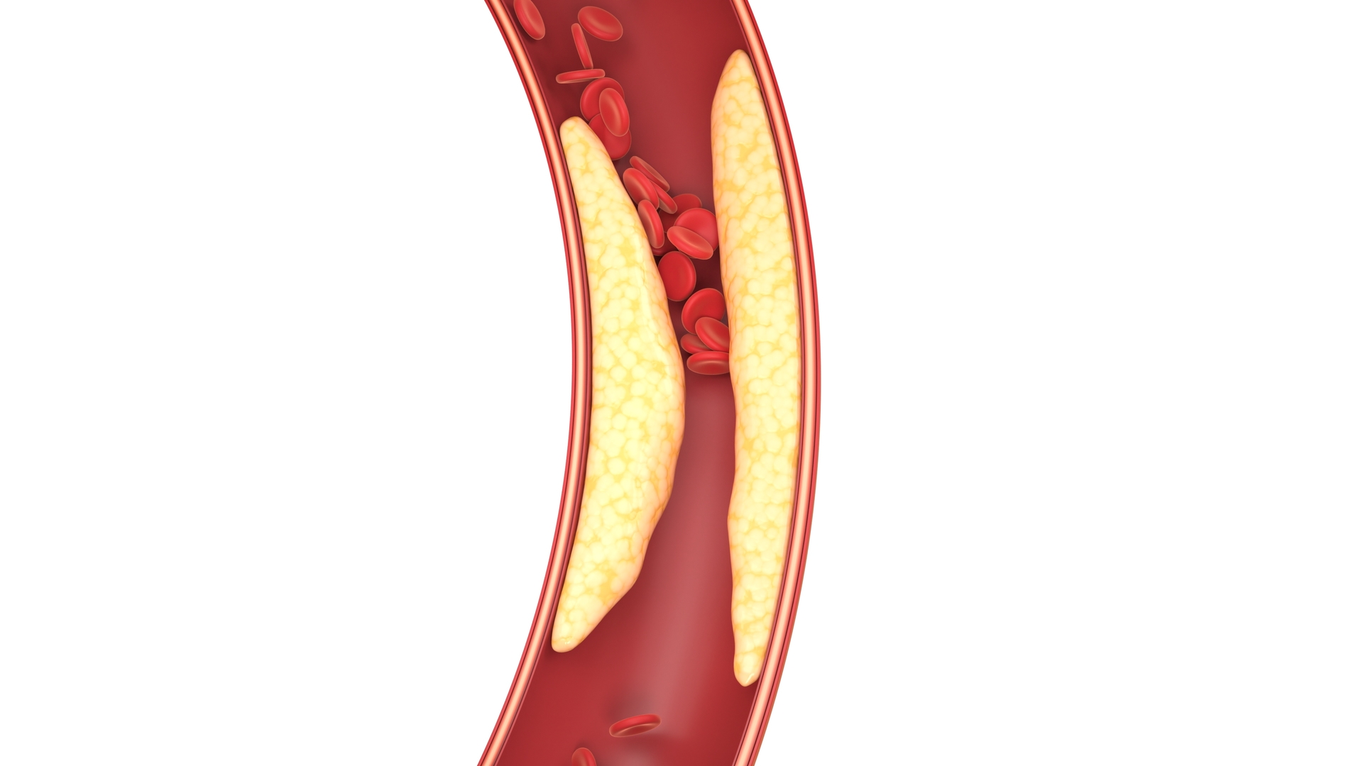 Atherosklerose
