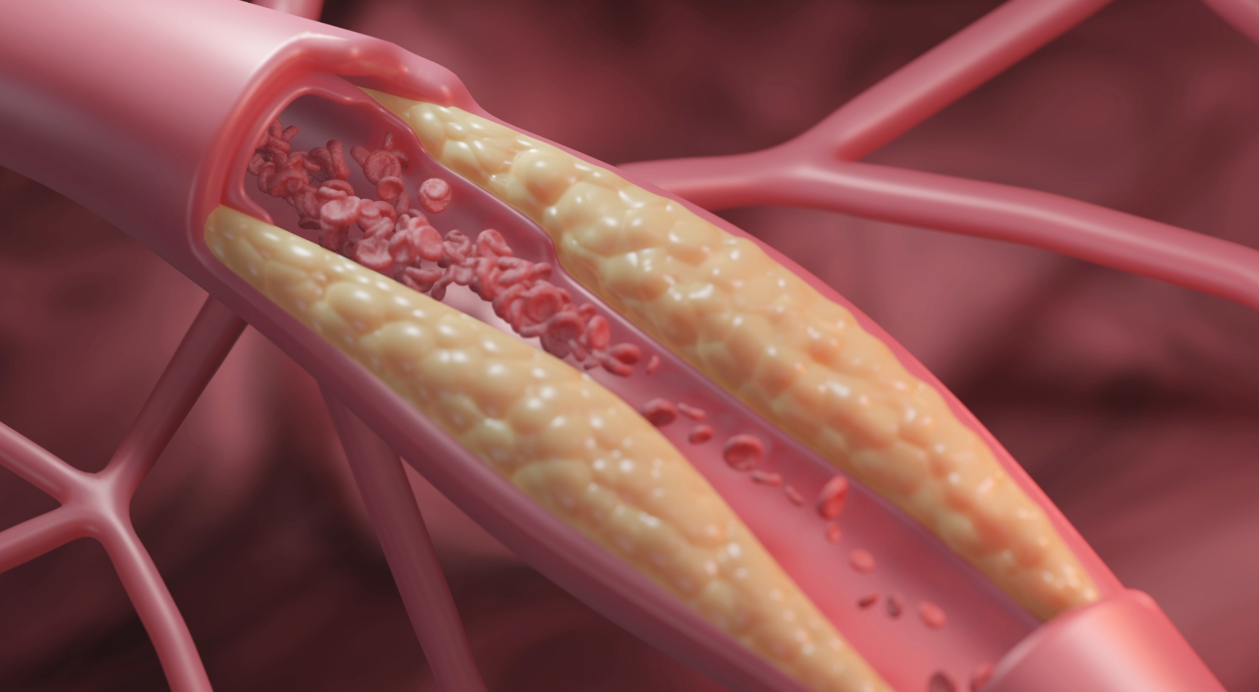 Athersklerose Ausschnitt